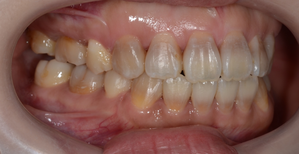 デコボコで開口を矯正した後の歯並び