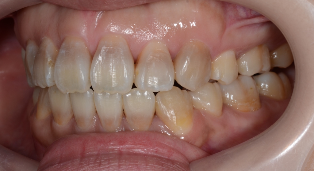 デコボコで開口を矯正した後の歯並び