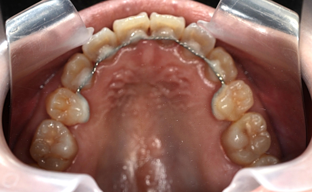 デコボコで開口を矯正した後の歯並び