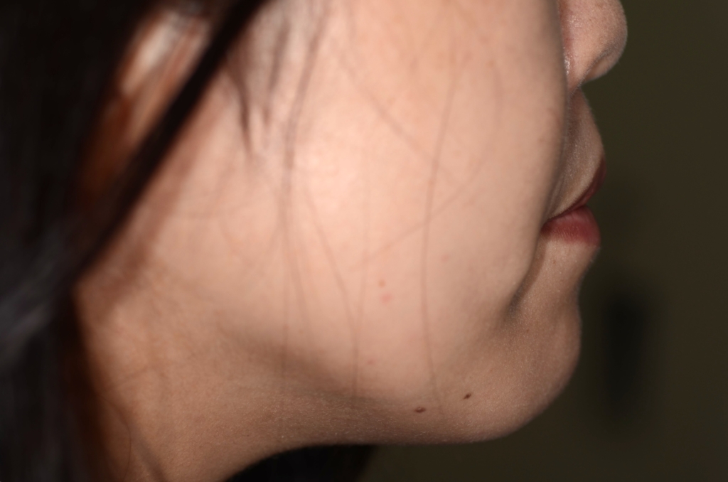 デコボコで開口を矯正した後の横顔と口元