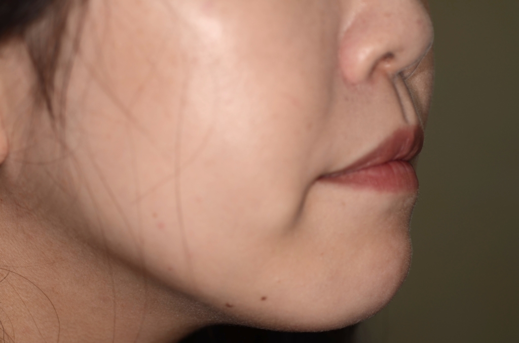デコボコで開口を矯正した後の横顔と口元