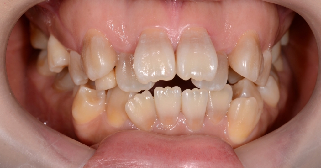 デコボコで開口を矯正する前の歯並び