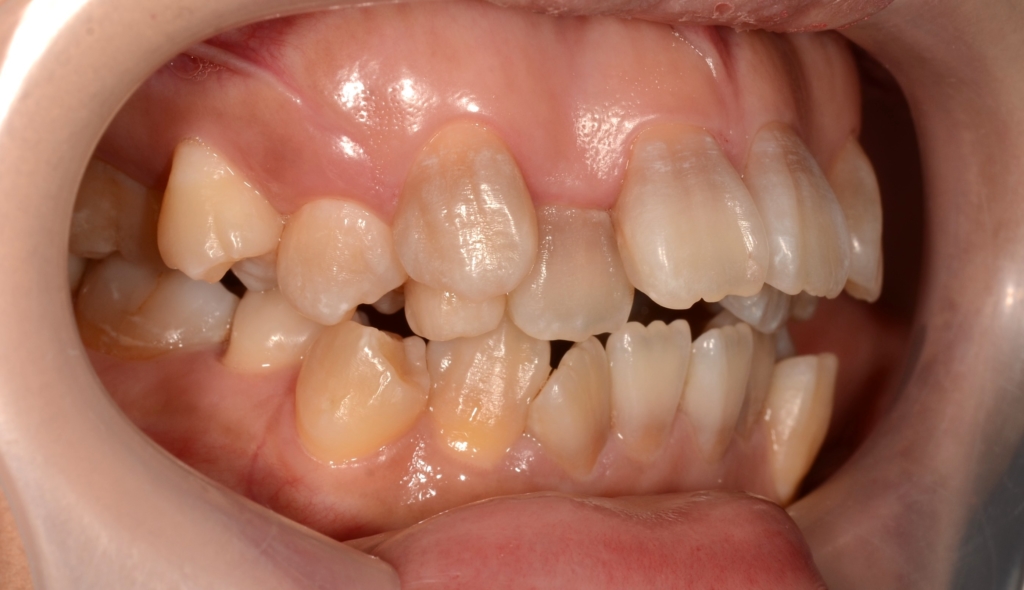 デコボコで開口を矯正する前の歯並び
