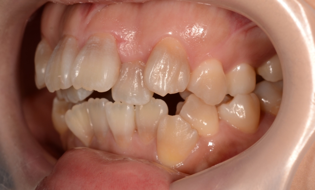 デコボコで開口を矯正する前の歯並び
