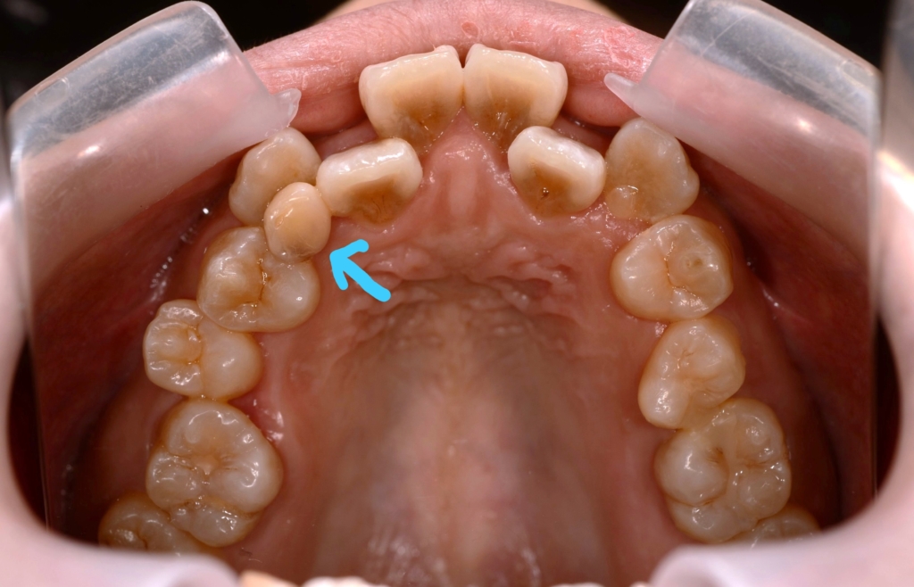 デコボコで開口を矯正する前の歯並び
