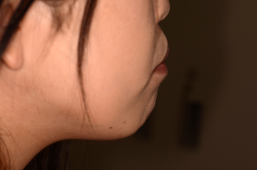 デコボコで開口を矯正する前の横顔と口元