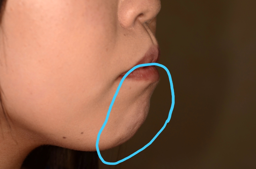 デコボコで開口を矯正する前の横顔と口元