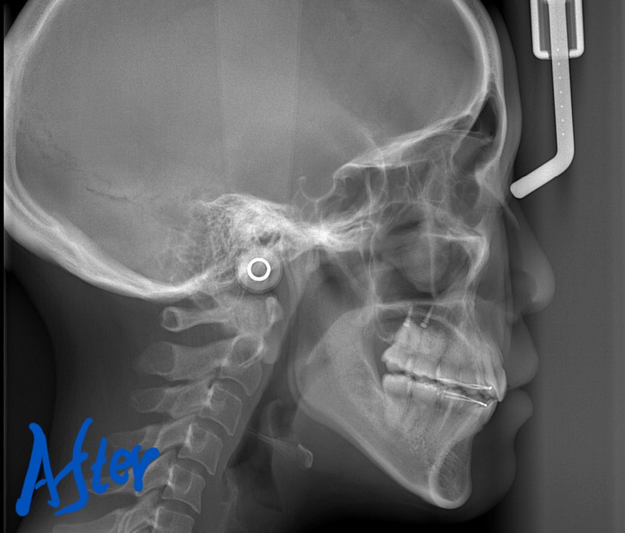 デコボコで開口を矯正した後の頭部を横から見たレントゲン写真