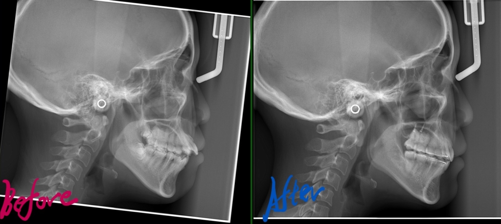 デコボコで開口を矯正した治療前後のレントゲン写真による比較