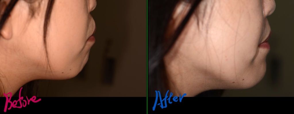 デコボコで開口を矯正した治療前後の横顔と口元の変化の比較