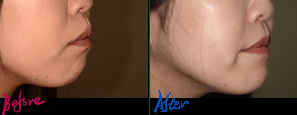 デコボコで開口を矯正した治療前後の横顔と口元の変化の比較