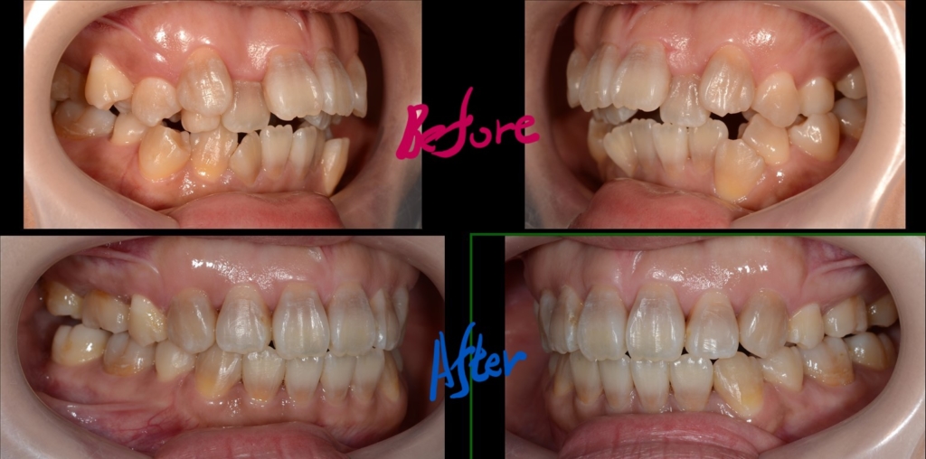 デコボコで開口を矯正した治療前後の歯並びの変化の比較