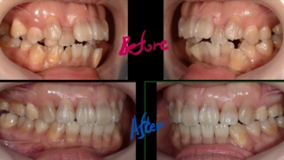 デコボコで開口を矯正した治療前後の歯並びの変化の比較
