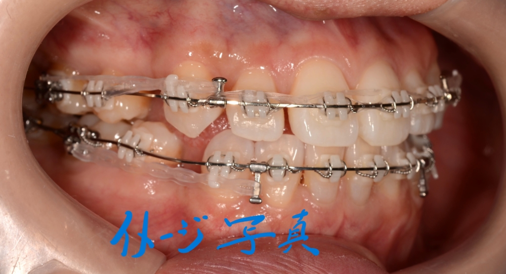 マルチブラケットシステムにて抜歯スペースを閉じている途中
