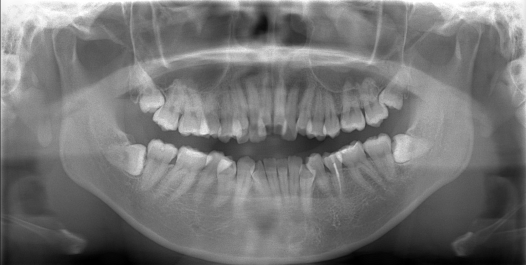 デコボコで開口を矯正する前の顎全体のレントゲン写真