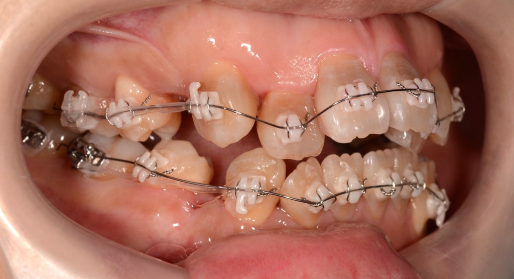 マルチブラケットシステムで矯正治療開始