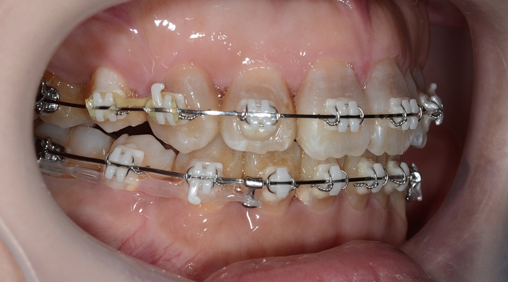 マルチブラケットシステムで矯正治療途中