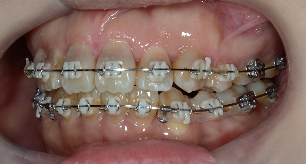 マルチブラケットシステムで矯正治療途中