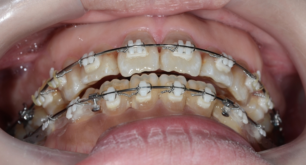 マルチブラケットシステムで矯正治療途中