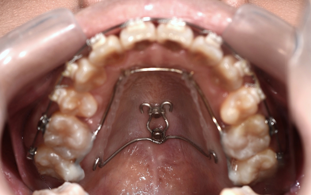 アンカースクリューを用いた矯正治療