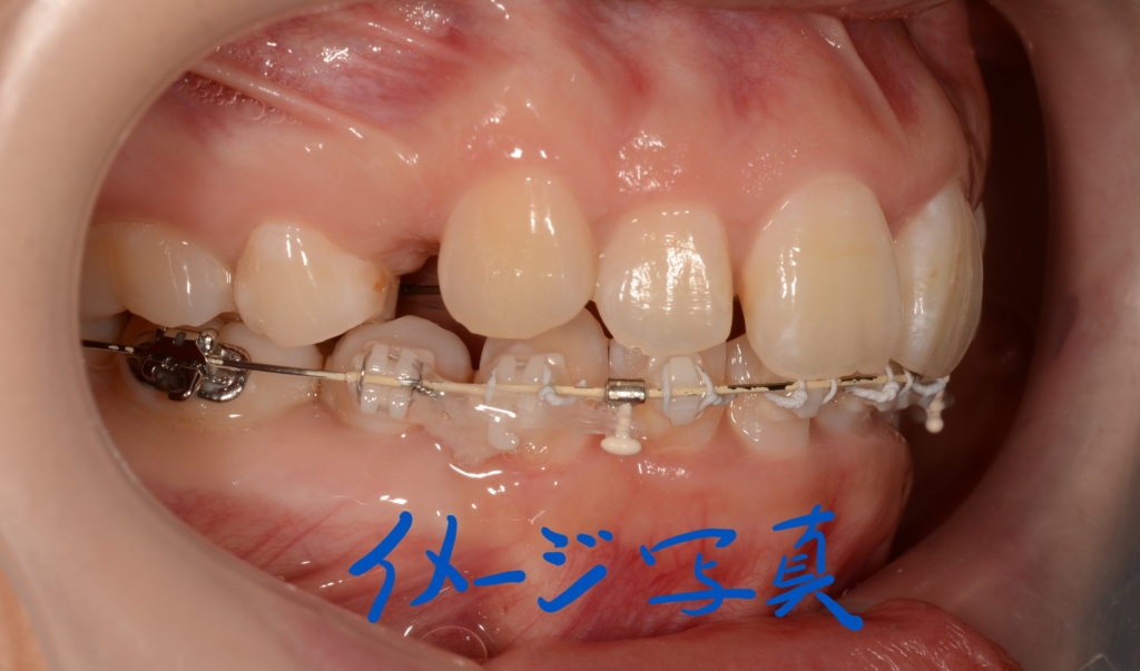 マルチブラケットシステムで矯正治療。 上顎は裏側矯正を用いたハーフリンガル