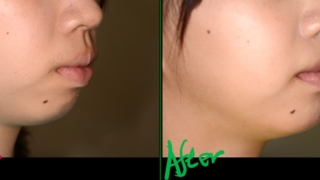 口ゴボを矯正した治療前後の横顔と口元の変化の比較