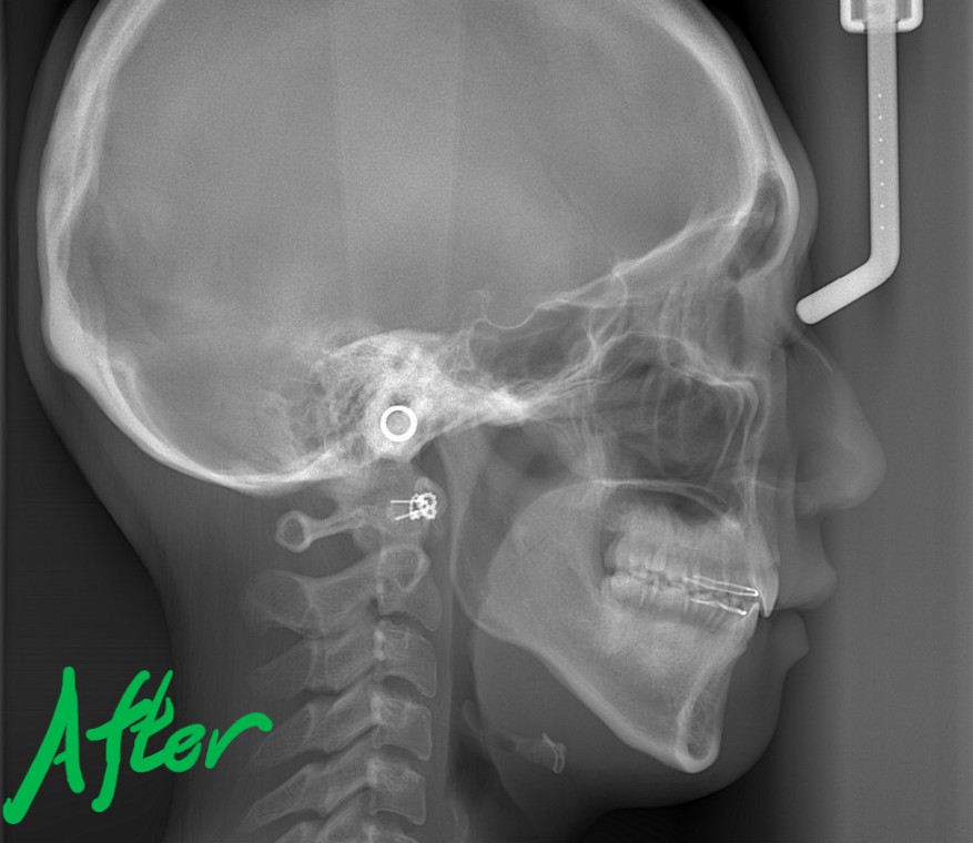 口ゴボを矯正した後の頭部を横から見たレントゲン写真