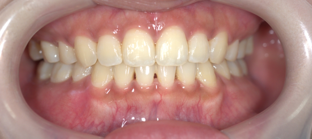 口ゴボを矯正した後の歯並び