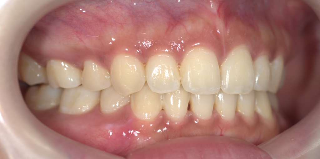 口ゴボを矯正した後の歯並び