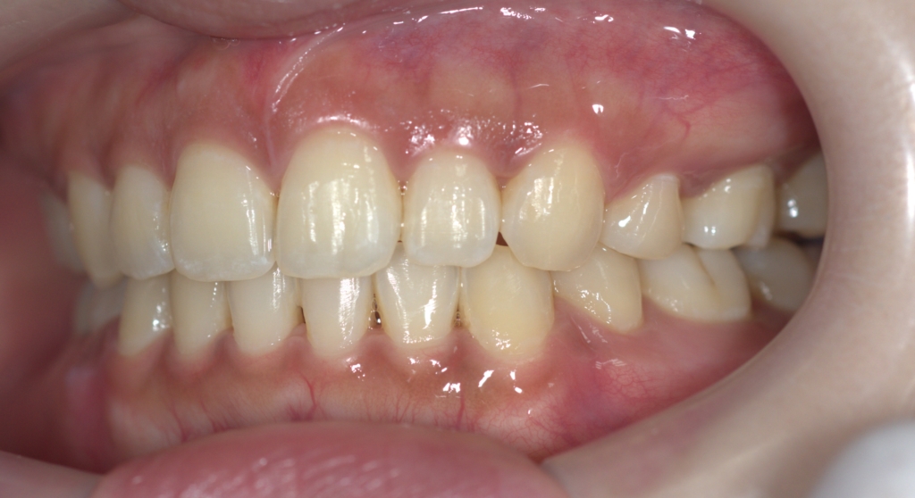 口ゴボを矯正した後の歯並び