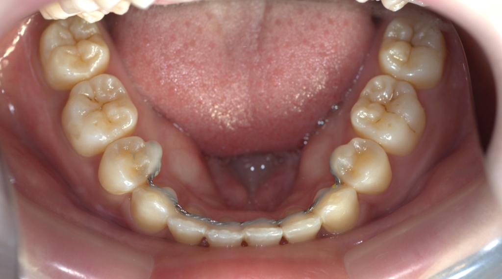 口ゴボを矯正した後の歯並び
