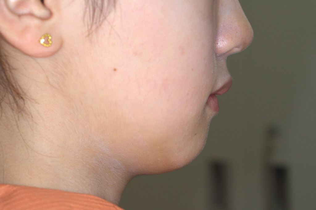 口ゴボを矯正した後の横顔と口元