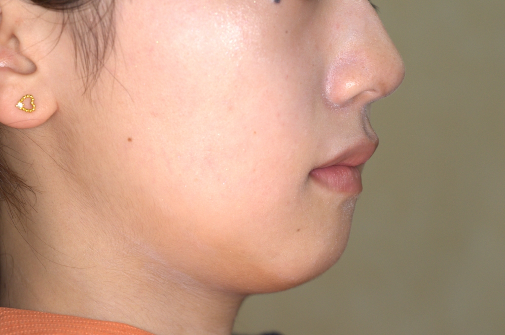 口ゴボを矯正した後の横顔と口元