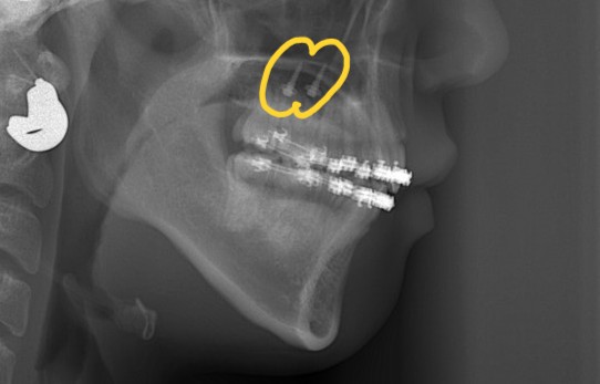 上顎の口蓋部にアンカースクリューを植立