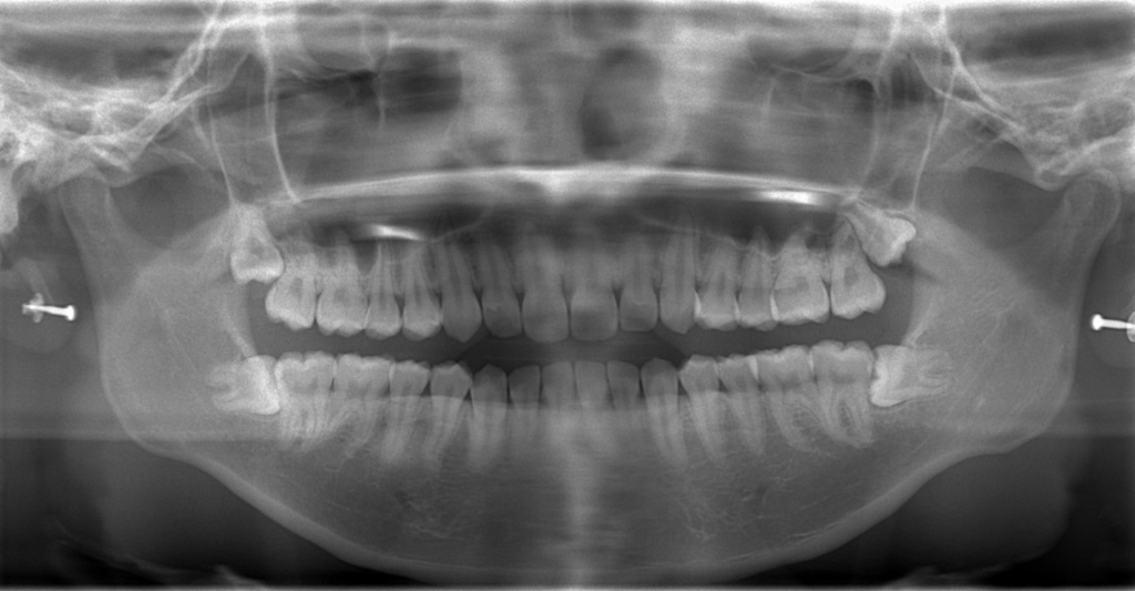 口ゴボを矯正する前の顎全体のレントゲン写真