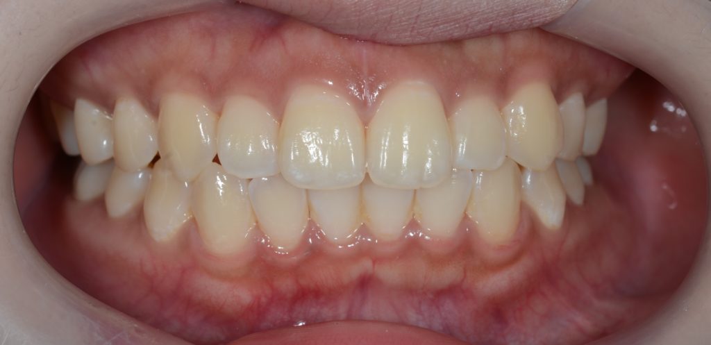 口ゴボを矯正する前の横顔と口元