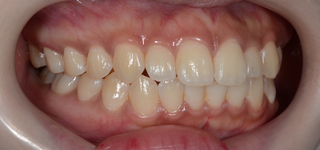 口ゴボを矯正する前の横顔と口元