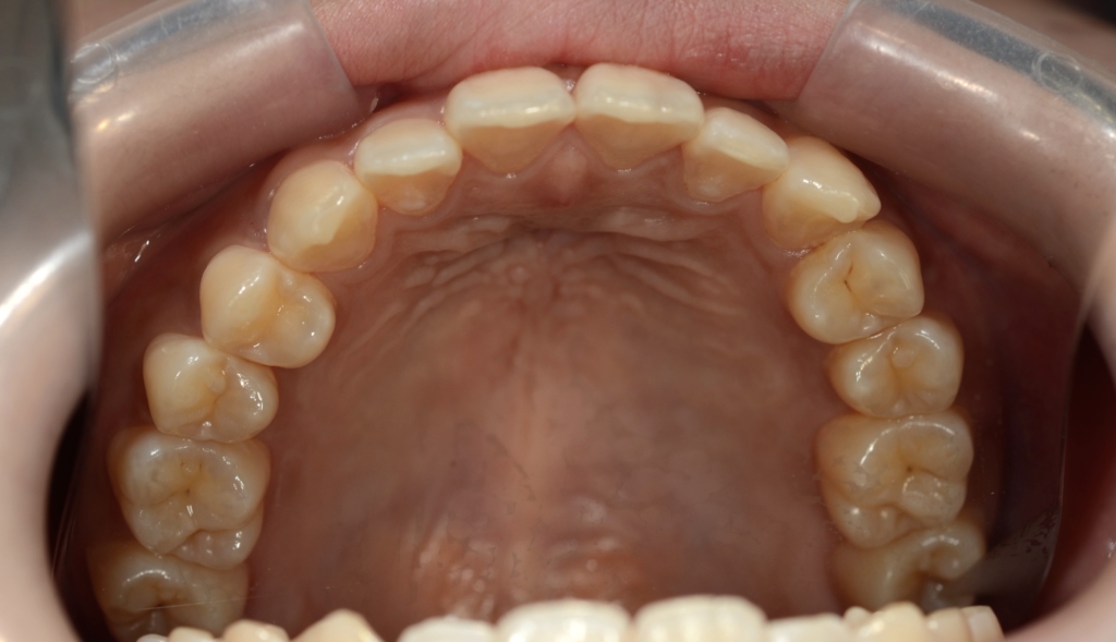 口ゴボを矯正する前の横顔と口元
