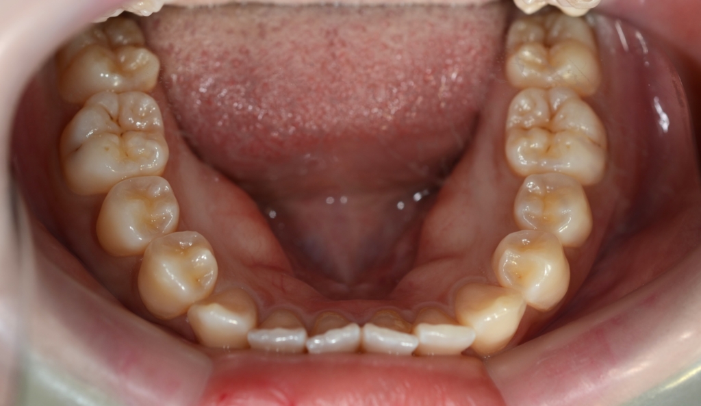 口ゴボを矯正する前の横顔と口元