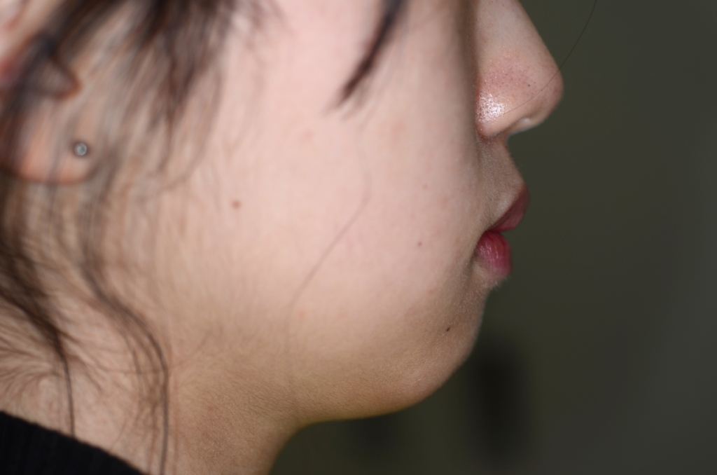 口ゴボを矯正する前の横顔と口元