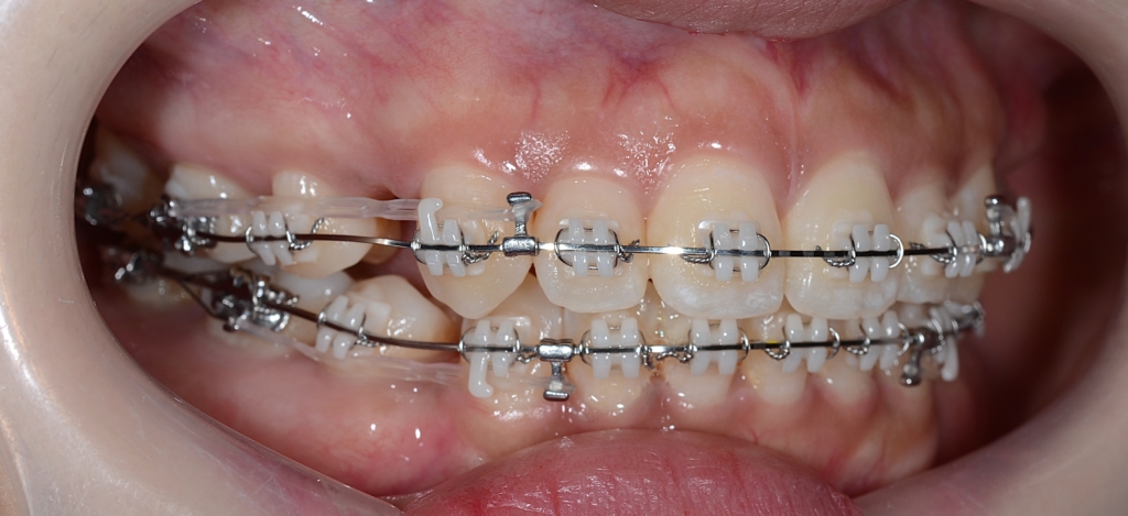 マルチブラケットシステムにて矯正治療中