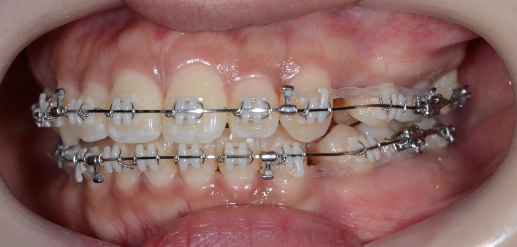 マルチブラケットシステムにて矯正治療中