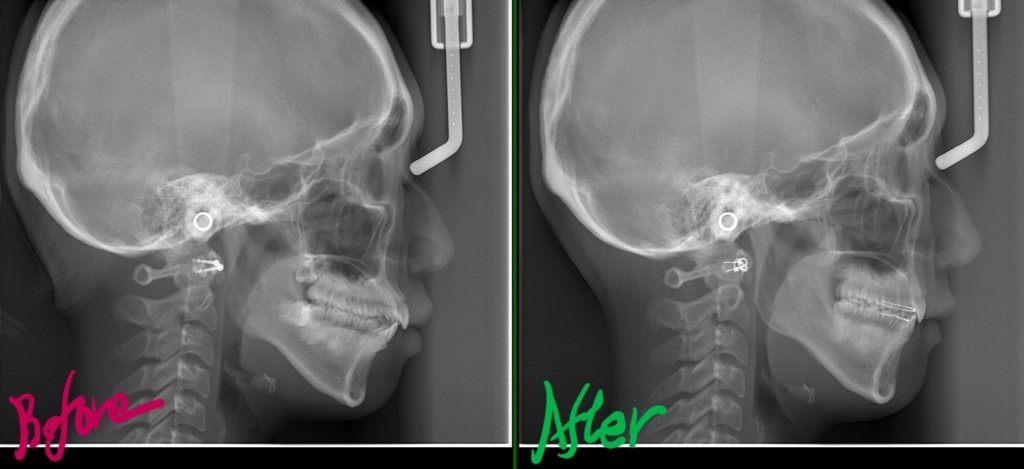口ゴボを矯正した治療前後のレントゲン写真による比較