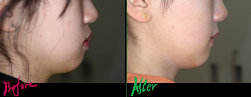 口ゴボを矯正した治療前後の横顔と口元の変化の比較