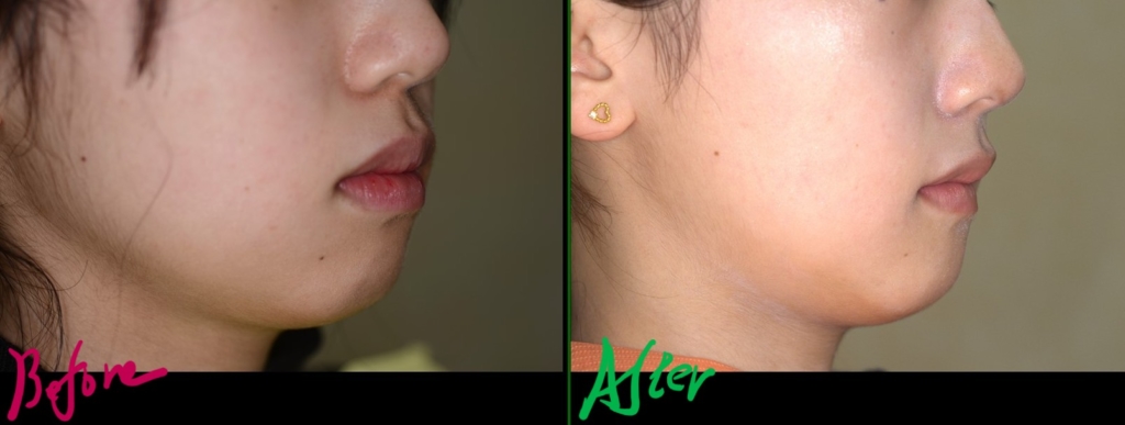 口ゴボを矯正した治療前後の横顔と口元の変化の比較