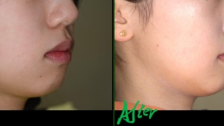 口ゴボを矯正した治療前後の横顔と口元の変化の比較