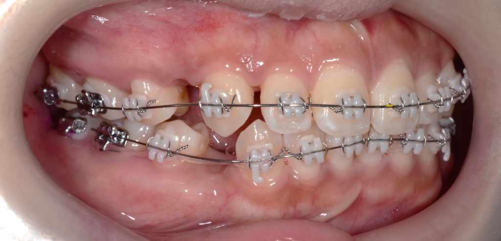 マルチブラケットシステムにて矯正治療を開始