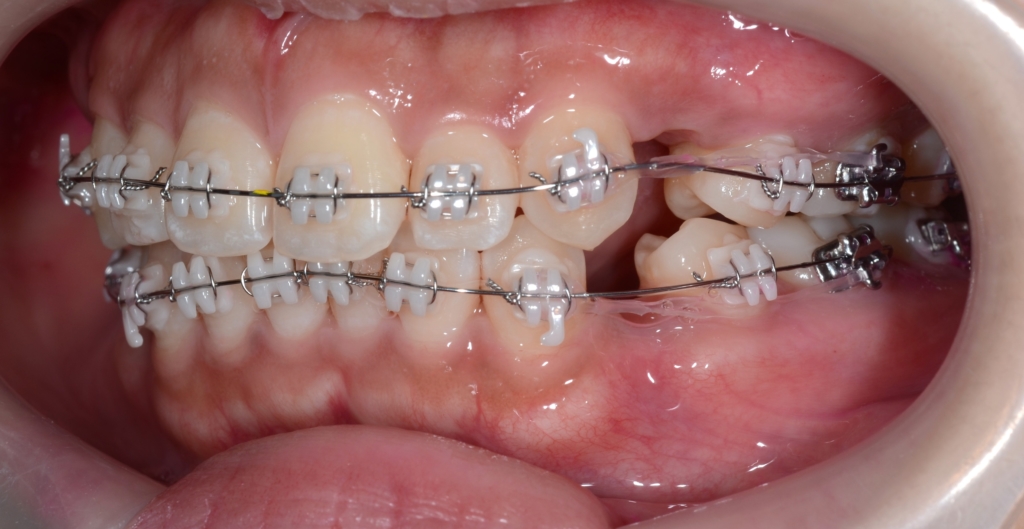 マルチブラケットシステムにて矯正治療を開始