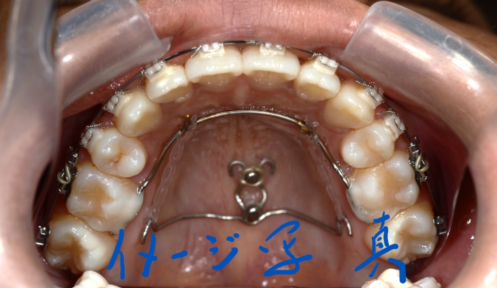 アンカースクリューを用いた矯正治療