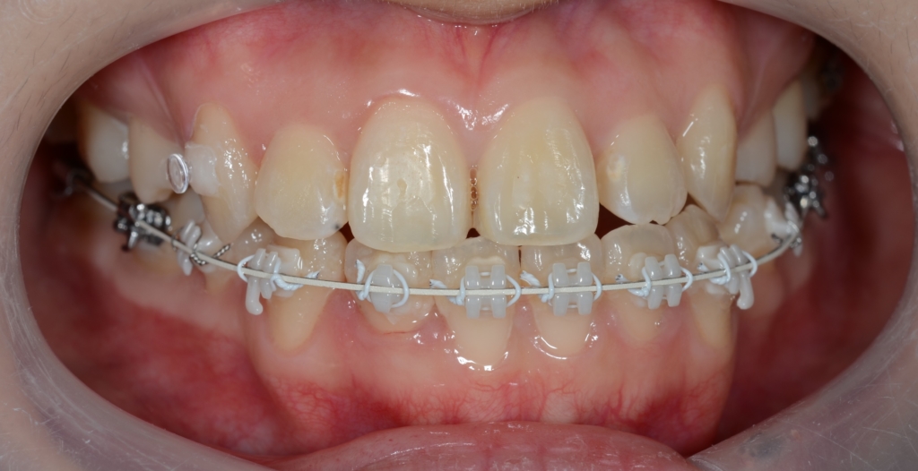 マルチブラケットシステムで矯正治療。 上顎は裏側矯正を用いたハーフリンガル